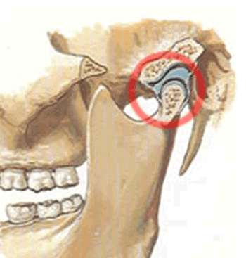 m&acirc;choire ferm&eacute;e